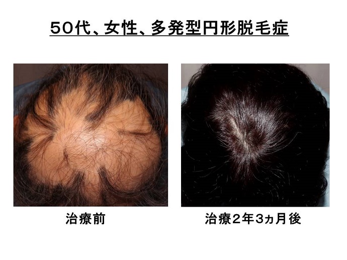 円形脱毛症　病院